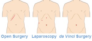 cholecystectomy-incision-comparison-en